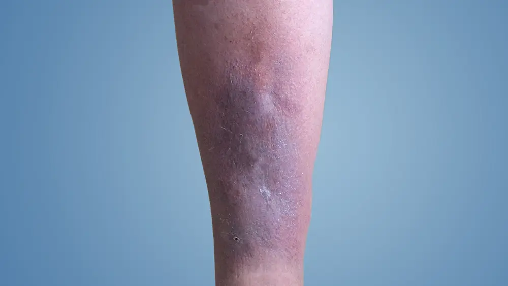 الجلطات الوريدية